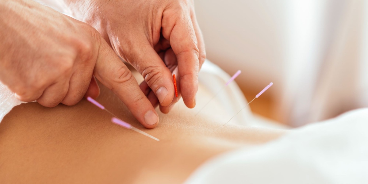 Acupuncture service photo